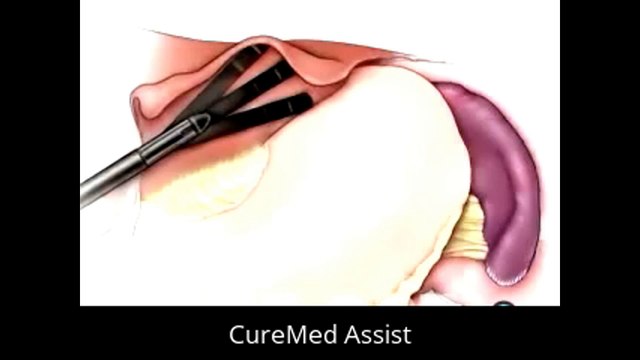 Patient Education Spleen Removal Laparoscopic Splenectomy Surgery 2 – CureMed Assist – Medical Tourism Company
