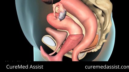 Pessary Is A Cure For Pelvic Organ Prolapse – CureMed Assist – Medical Tourism Company