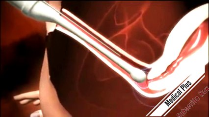 How in vitro fertilization works