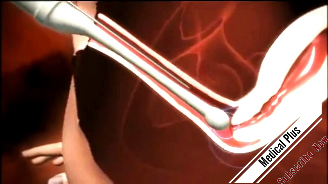 How in vitro fertilization works