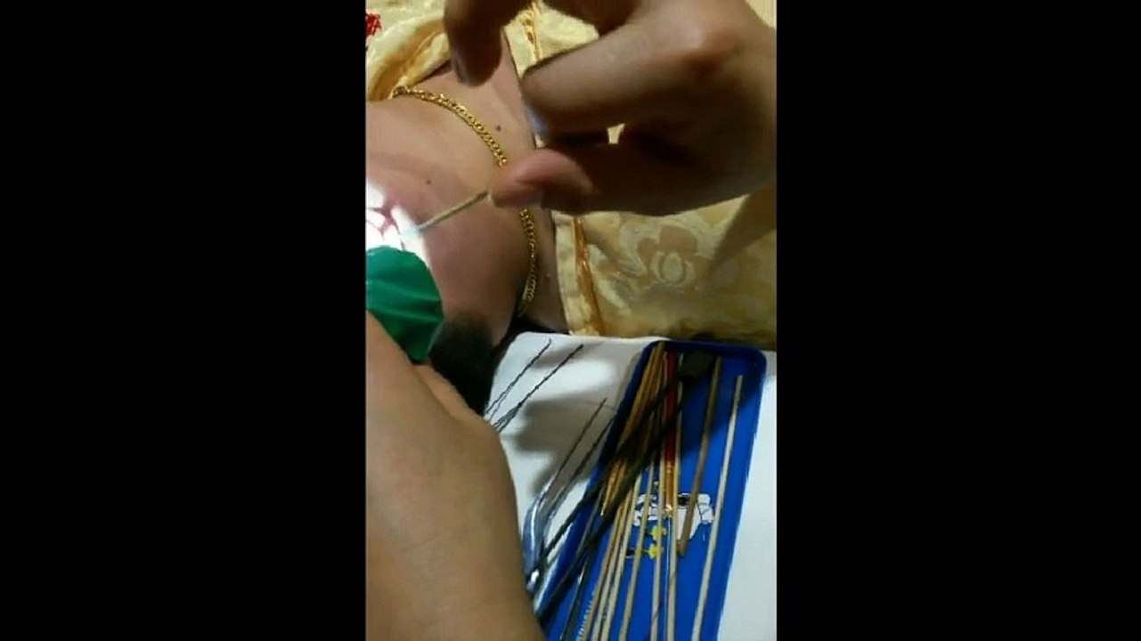 Chinese Ear Cleaning (28) 8 minutes of Ear Cleaning Relaxation and Stress Relief l