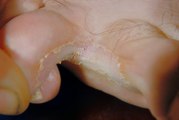 If A Fungal Rash Occurs, How Should The Area Be Cleansed And Treated?
