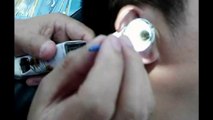 Chinese Ear Cleaning (105) DIY Using ear pick and twezzer to clean out a large piece of ear wax