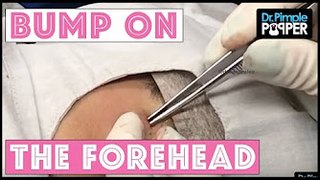 A Bluish Bump Squeezed on the Forehead - YouTube & Dr Sandra Lee