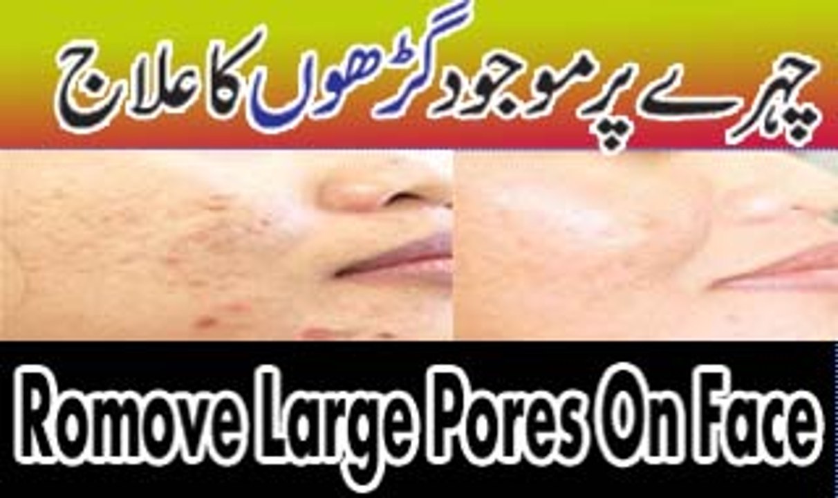 Chehre K Garon Khulay Masaamo Ka Ilaaj | Tighten Pores Permanently
