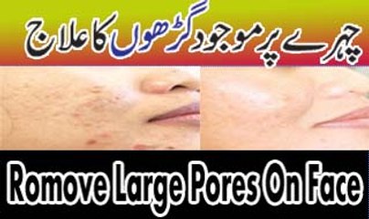 Chehre K Garon Khulay Masaamo Ka Ilaaj | Tighten Pores Permanently