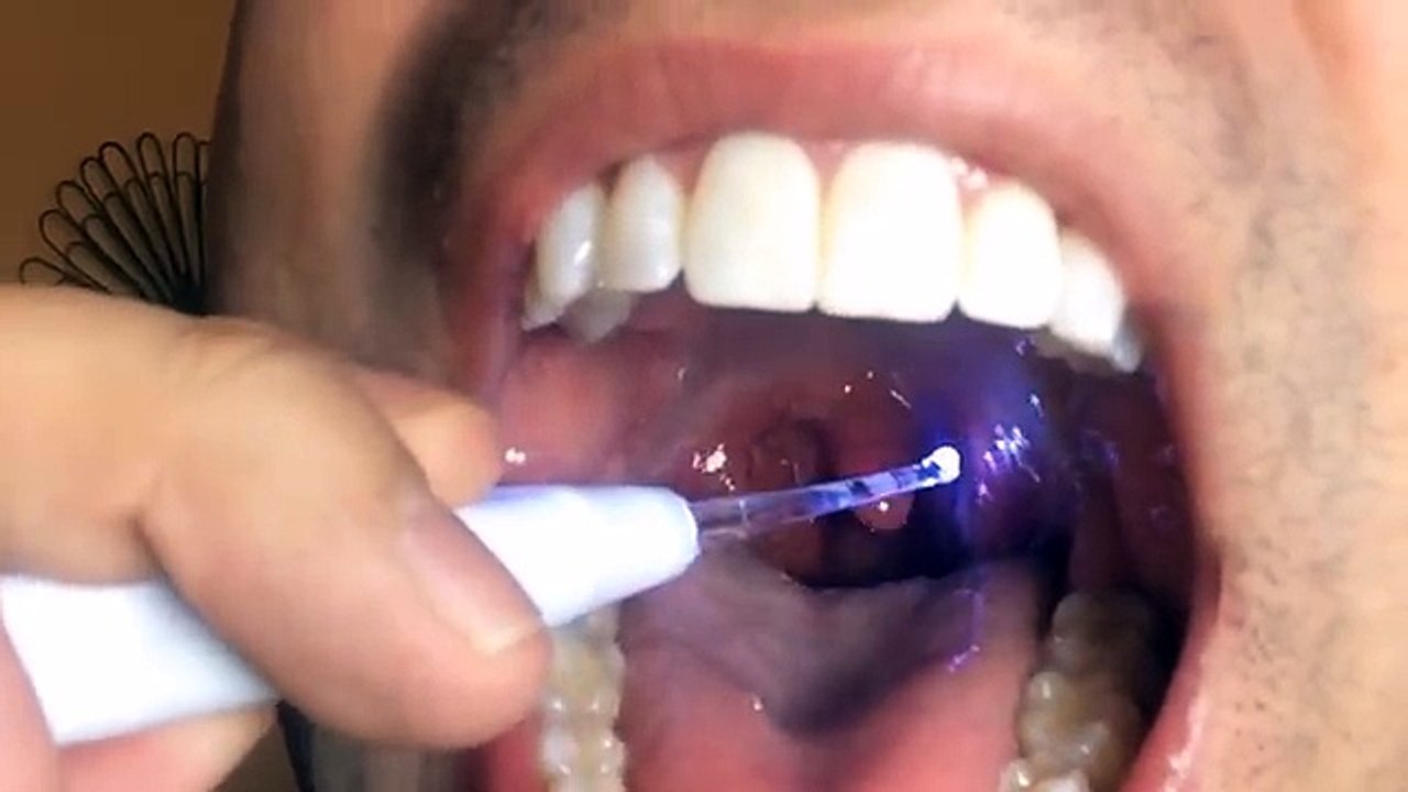 Extreme Tonsil Stone Removal