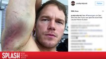 Chris Pratt Shows Terrible Bruises From 'Passengers' Stunts