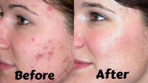 How to Get Rid of Acne Scars Overnight | Get Rid of Acne Scars Naturally At Home - Tips To Get Rid of Acne Scars