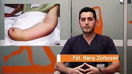 Lenfödem nedir, nasıl tedavi edilir?