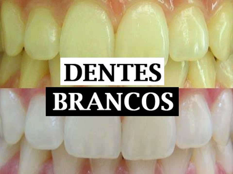 Como clarear os dentes