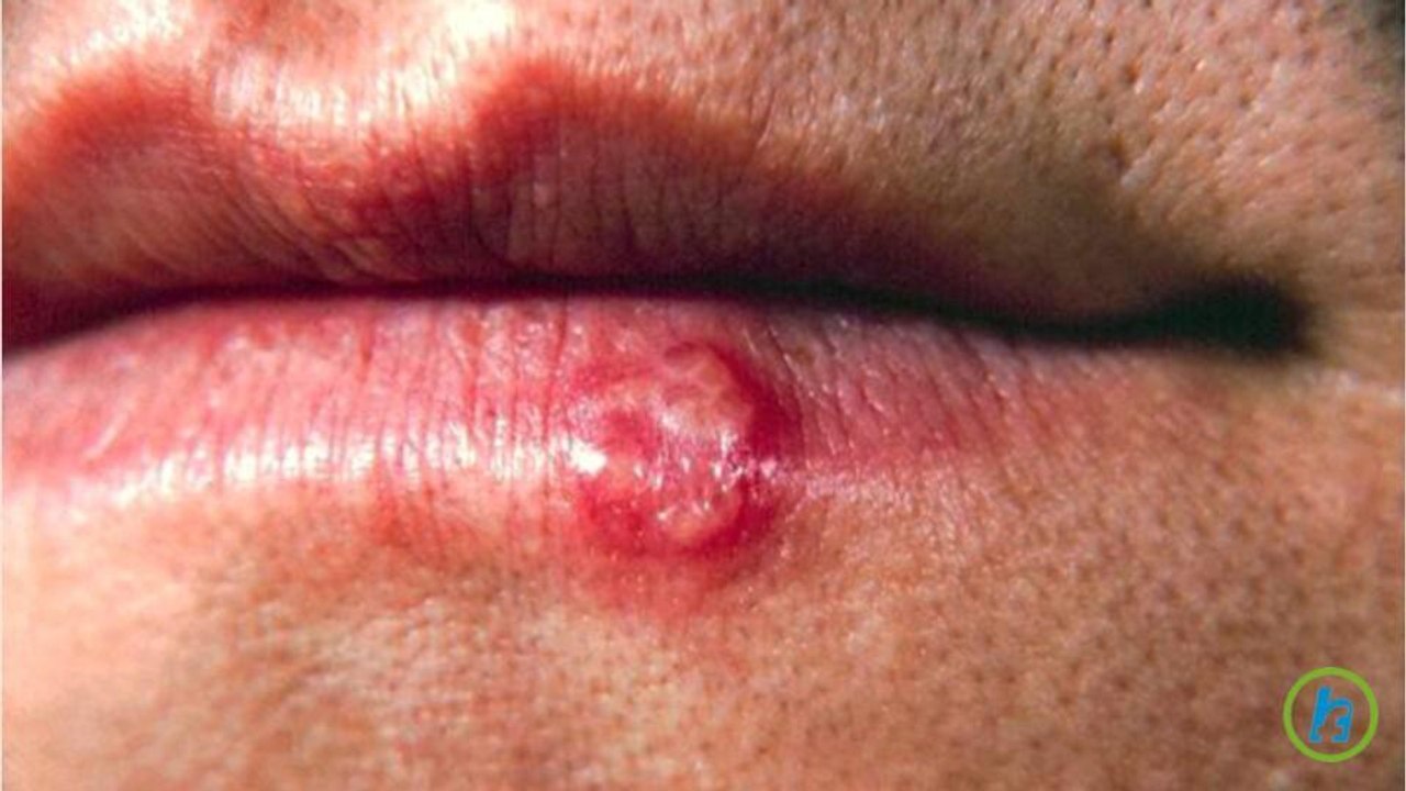 What Is Oral Herpes Or Cold Sores?