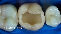 Ovaj VIDEO gledat cete u jednom dahu – Evo kako vam zubar popravlja zube