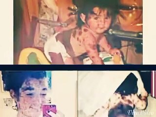 This Girl Was Born With Black Birthmarks But Now Look At Her 19 Years Later