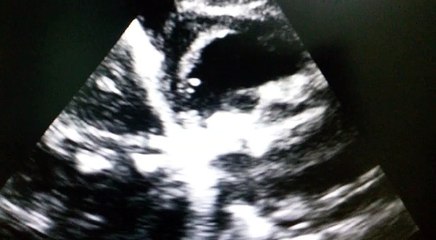 Mitral Valve Thrombosis On Echocardiography