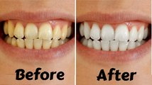 How To Whiten Teeth At Home | Tips To Whiten Teeth Naturally (Fast & Quickly)