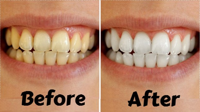 How To Whiten Teeth At Home | Tips To Whiten Teeth Naturally (Fast & Quickly)
