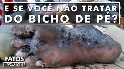 O que acontece se você não tratar do bicho de pé