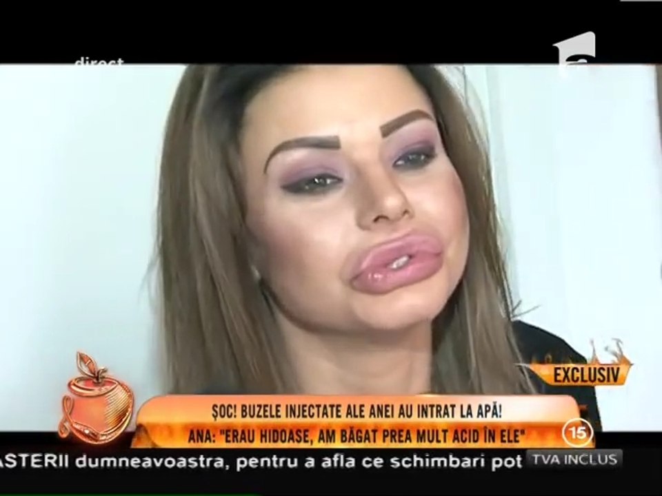 Ana Mocanu, și-a făcut  buze de cal!