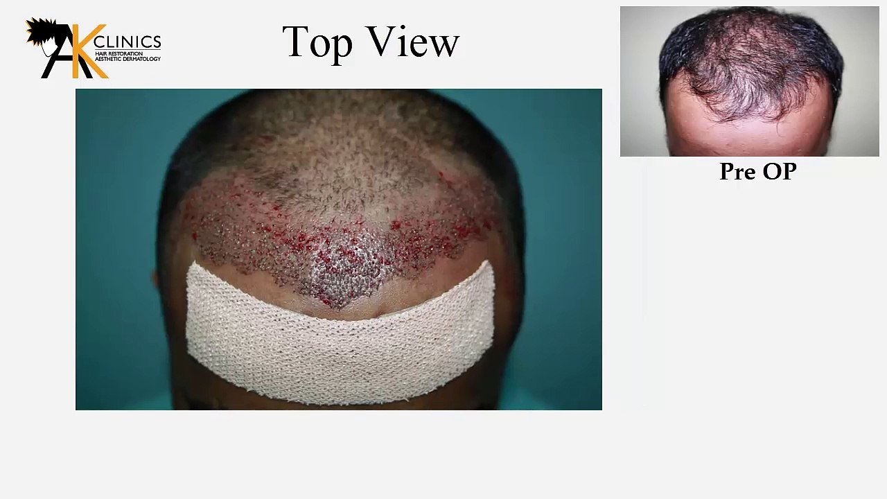 1400 Grafts FUE Hair Transplant Surgery Result After 8 Month - Delhi, India
