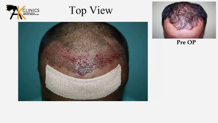 1400 Grafts FUE Hair Transplant Surgery Result After 8 Month - Delhi, India