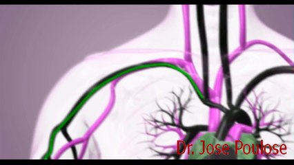| Angioplasty Medical Treatment | Dr Jose Poulose | Jose Poulose |