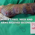 Fish scales heal woman's burned body