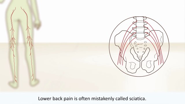 Vancouver Spine & Disc Centre Reveals What is Sciatica