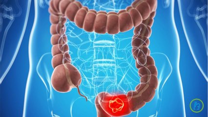 Lifestyle Tips to Reduce Colon Cancer Risk
