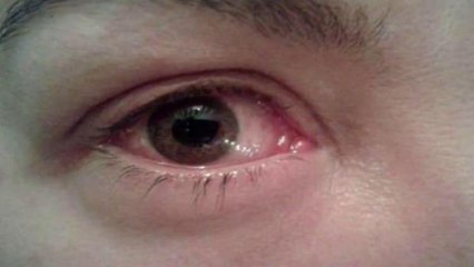 Conjuntivite pode se propagar no verão e em lugar com ar condicionado