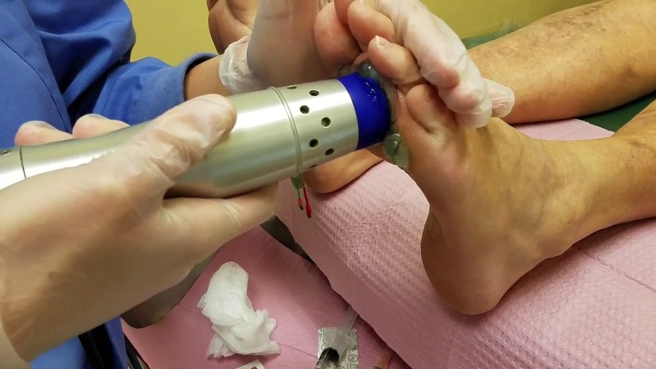Neuroma cure without surgery