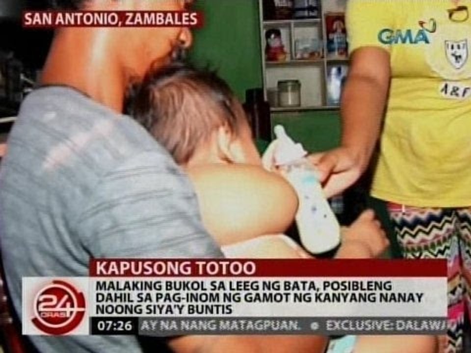 Malaking bukol sa leeg ng bata, posibleng dahil sa pag-inom ng gamot ng kanyang nanay noong buntis