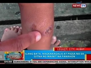 BP: Ilang bata sa Legazpi City, Albay, nagkakagalis at pigsa na sa gitna ng mainit na panahon
