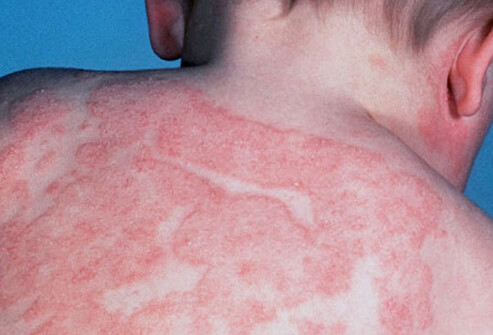 Allergic Skin Disorders: Eczema