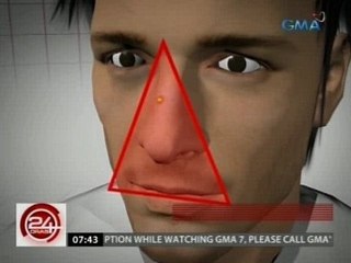 24 Oras: Dangerous triangle area sa mukha, dapat ingatan dahil delikado 'pag nagka-impeksyon