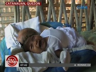 3 buwang gulang na sanggol, pinahihirapan ng bukol na mas malaki pa sa kanyang ulo