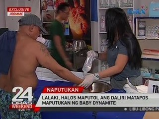 Lalaki, halos maputol ang daliri matapos maputukan ng baby dynamite