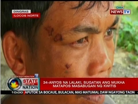 SONA: Mga nabibiktima ng paputok ngayong taon, umabot na sa 70