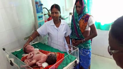 Mother shocked because conjoined twins exotic