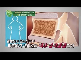 ‘골다공증’ 자가 진단법! OO만 봐도 알 수 있다?_채널A_닥터지바고 70회
