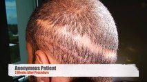 Compare Hair Transplant Scars - Don't Get A Bad Hair Transplantscar!