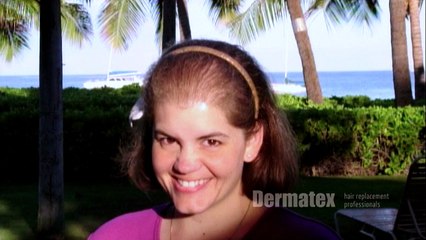 Dermatex Womens Hair Replacement