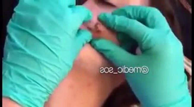 Genç Kızın Yüzündeki Sivilcenin Patlatılması !!! , Sivilce Sıkma , Sivilce Patlatma
