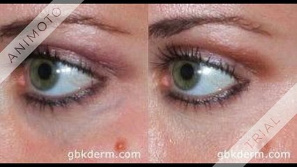 sclerotherapy | Get best treatment in san diego