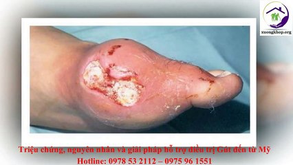 Hình thành Tophi - Biến chứng nguy hiểm của bệnh Gút