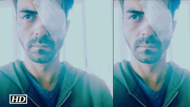 OMG: Arjun Rampal suffers an EYE INJURY