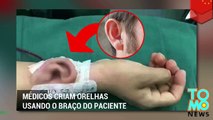 Médicos criam orelha de paciente em seu braço.