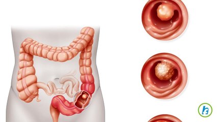 Colon Cancer Location Affects Patient Survival Rate, study finds