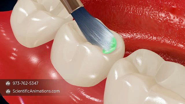 Dental Sealant - Dental Reconstruction or Tooth Decay Treatment