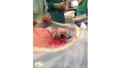 Le bébé sort littéralement du ventre de sa mère et les médecins ne font rien!